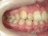 矯正歯科　治療前　右