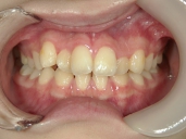 矯正歯科　治療前　正面