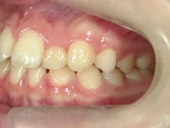 矯正歯科　治療前　左
