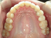 矯正歯科　治療後　上顎