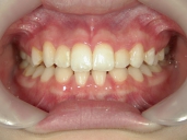 矯正歯科　治療後　正面