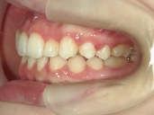 矯正歯科　治療後　左