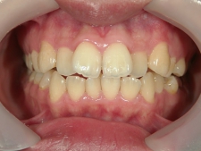 矯正歯科　治療前