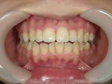 矯正歯科　プチワイヤー矯正　治療後