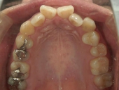 矯正歯科　治療前　上顎