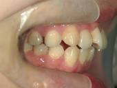 矯正歯科　治療前　右