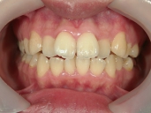 矯正歯科　治療前　正面