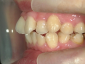 矯正歯科　治療前　左