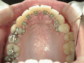 矯正歯科　治療後　左