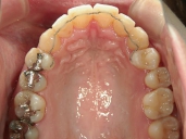 矯正歯科　治療後　上顎