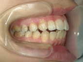 矯正歯科　治療後　右