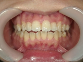 矯正歯科　治療後　正面