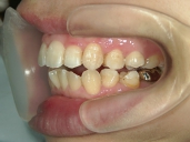 矯正歯科　治療後　左
