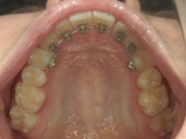 矯正歯科　治療後　左