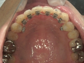 矯正歯科　治療後　左