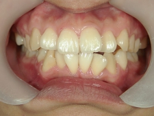 矯正歯科　治療前