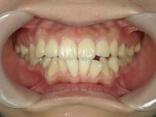 矯正歯科　プチワイヤー矯正　治療後