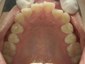 矯正歯科　治療前　上顎