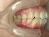 矯正歯科　治療前　右