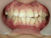 矯正歯科　治療前　正面