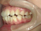 矯正歯科　治療前　左