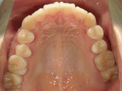 矯正歯科　治療後　上顎