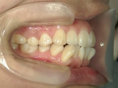 矯正歯科　治療後　右