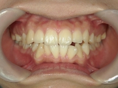 矯正歯科　治療後　正面