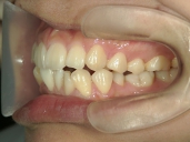 矯正歯科　治療後　左