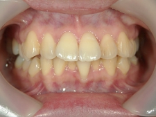 矯正歯科　治療前