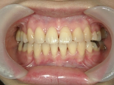 矯正歯科　全顎ワイヤー矯正　治療後