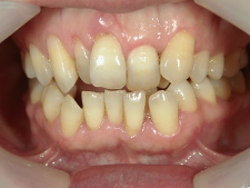 矯正歯科　治療前