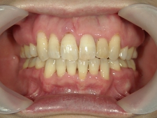 矯正歯科　全顎ワイヤー矯正　治療後