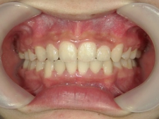 矯正歯科　全顎ワイヤー矯正　治療後