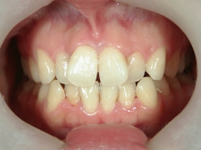 矯正歯科　治療前