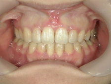 矯正歯科　全顎ワイヤー矯正　治療後