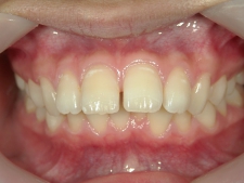 矯正歯科　治療前