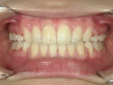 矯正歯科　全顎ワイヤー矯正　治療後