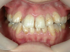 矯正歯科　治療前