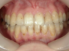 矯正歯科　全顎ワイヤー矯正　治療後