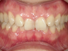 矯正歯科　治療前