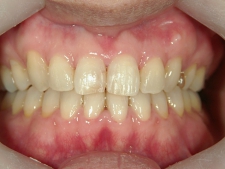 矯正歯科　全顎ワイヤー矯正　治療後