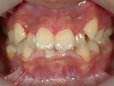 矯正歯科　治療前