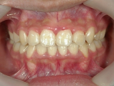 矯正歯科　全顎ワイヤー矯正　治療後