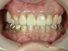 矯正歯科　プチワイヤー矯正　治療後