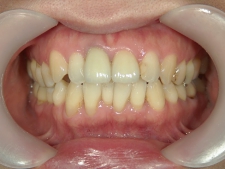 矯正歯科　治療前