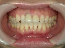 矯正歯科　プチワイヤー矯正　治療後