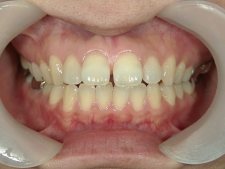 矯正歯科　治療前