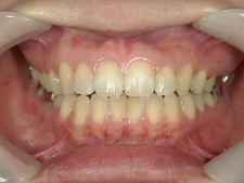 矯正歯科　プチワイヤー矯正　治療後