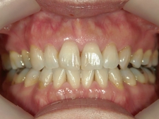 矯正歯科　治療前